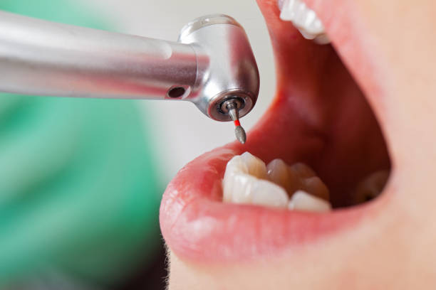 Best Emergency Dental Care for Broken or Chipped Teeth in Johnston City, IL